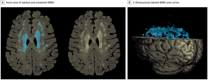 White Matter Hyperintensity