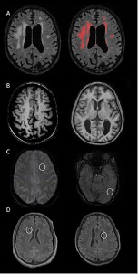 Cerebrovascular markers