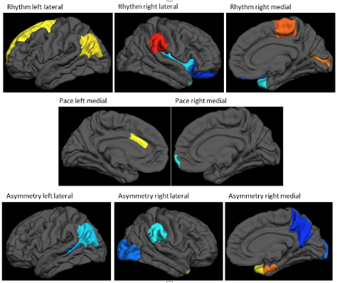 Figure cortical thickness patterns associated with 2 different gait measures
