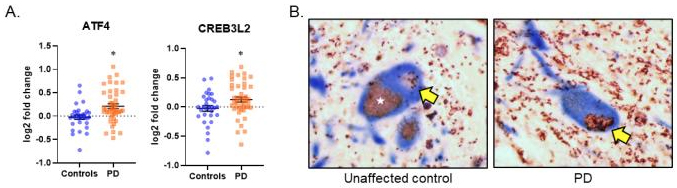 Figure 1 Increased expression and formation of the ATF4-CREB3L2 TF dimer in PD